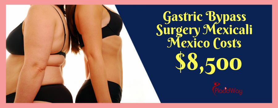 Gastric Bypass Mexico Cost in Mexicali
